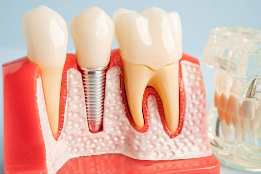 Dental Implants vs Dentures: What Seniors in Houston Need to Know